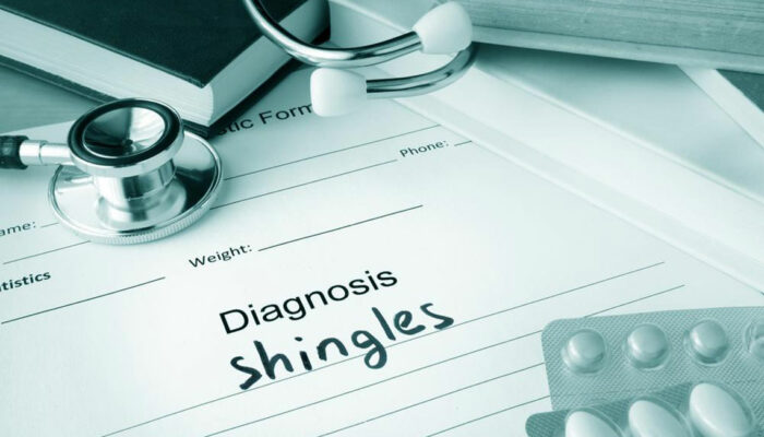 Natural Remedies for Shingles