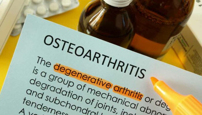 Osteoarthritis: Causes, symptoms, and treatments