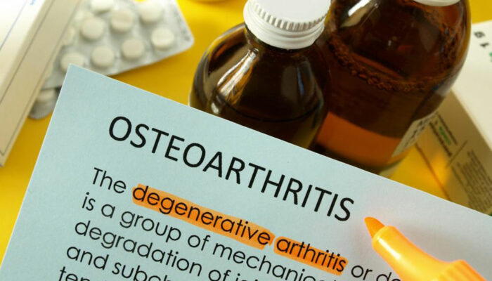 Osteoarthritis &#8211; How to Treat it