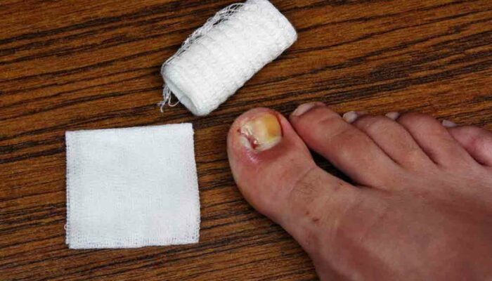 Popular Ways to Treat Toenail Fungus