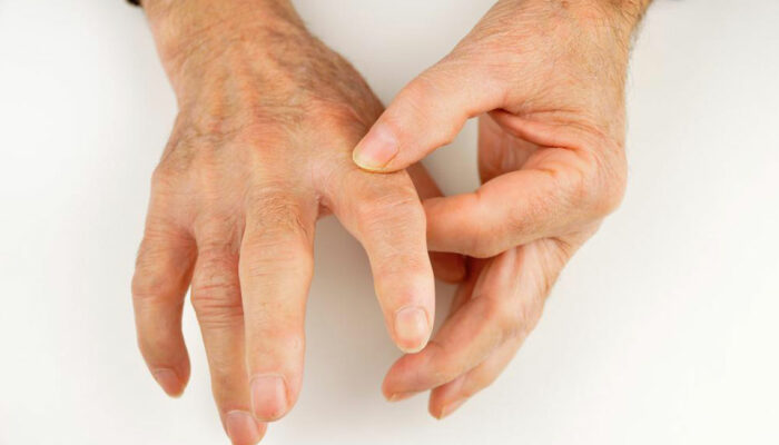 Popular Treatment Options for Rheumatoid Arthritis and Gout