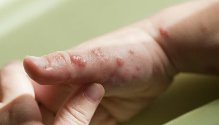 Popular Treatment Options for Shingles