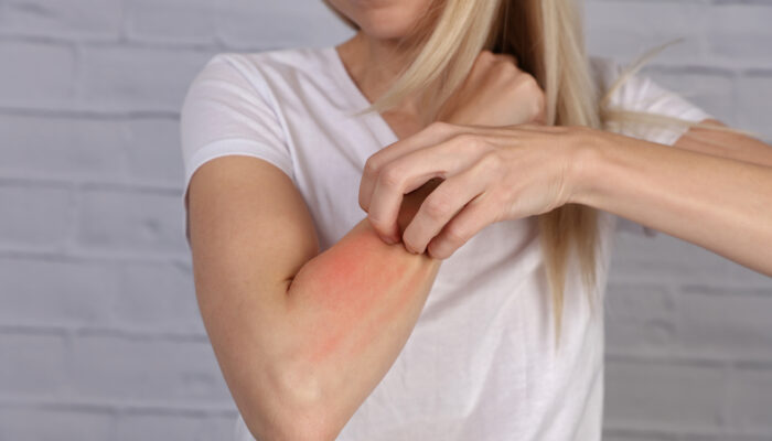 Psoriasis Medications And Their Side Effects