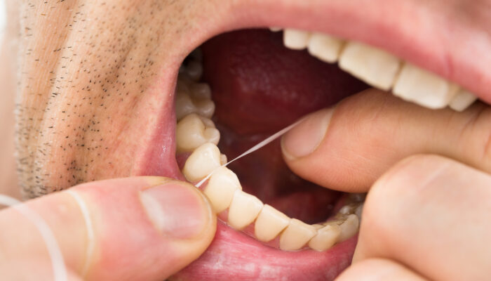 Removing Dental Plaque At Home