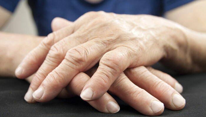 Rheumatoid Arthritis &#8211; Diagnosis and Treatment Options