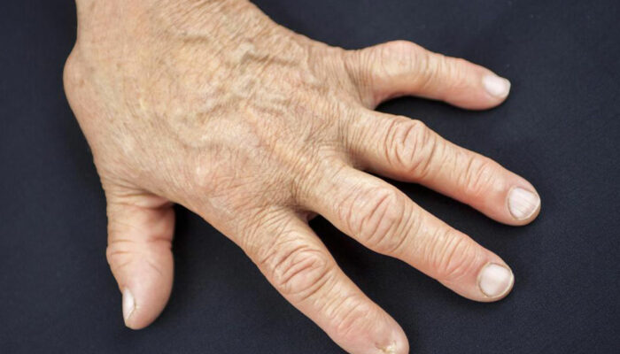 Signs of Rheumatoid Arthritis You Should Look out For