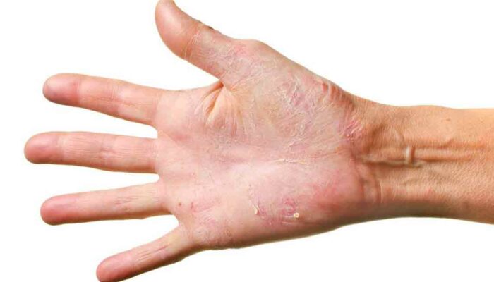 Six creams that can cure eczema