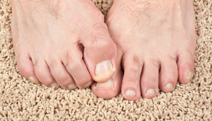 Some Effective Home Remedies for Toenail Fungus