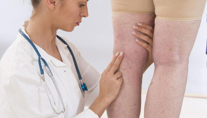 Standard Methods Used for the Treatment of Deep Vein Thrombosis