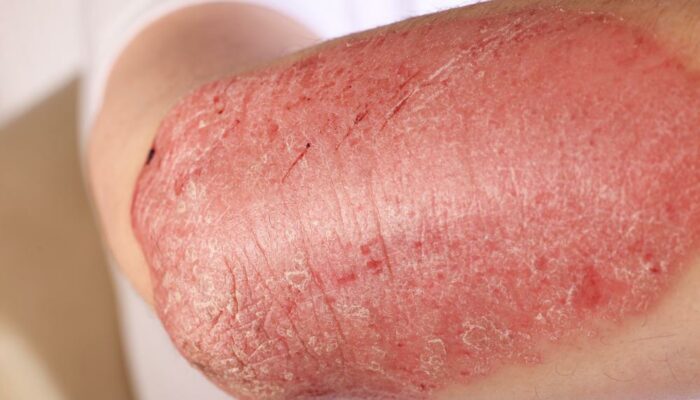 Symptoms, Causes, Types And Treament Of Eczema