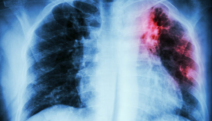 Symptoms and Diagnosis of a Pulmonary Embolism