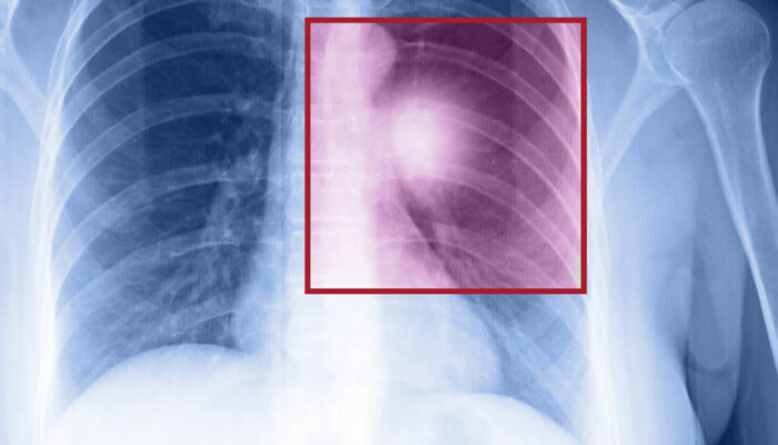 Symptoms and Treatment of Metastatic Lung Cancer