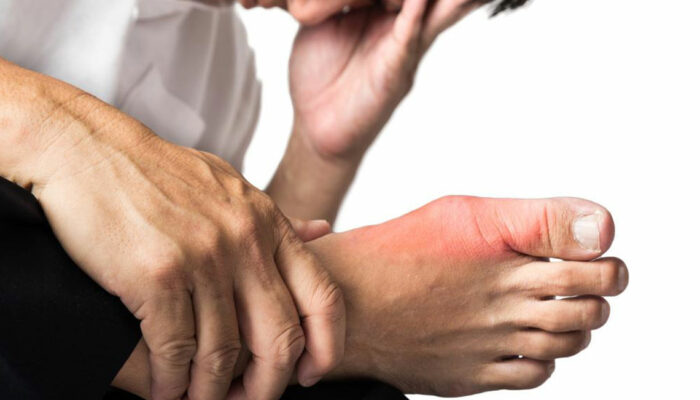 Symptoms and Treatments for Gout