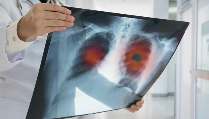 Symptoms and Treatments for Non-Small Cell Lung Cancer