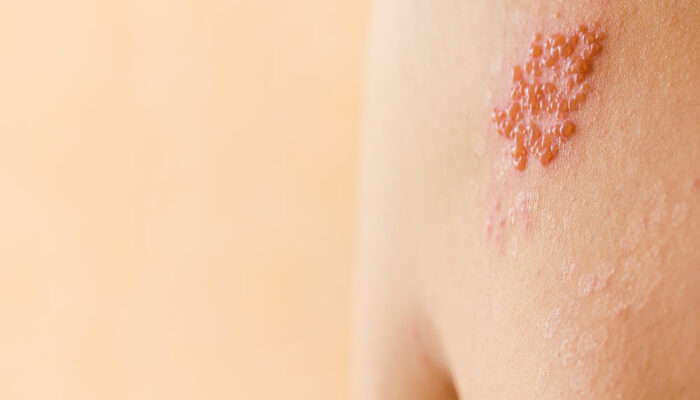 Symptoms and causes of shingles