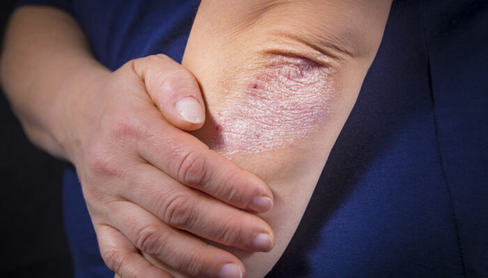 Symptoms and risk factors of psoriasis