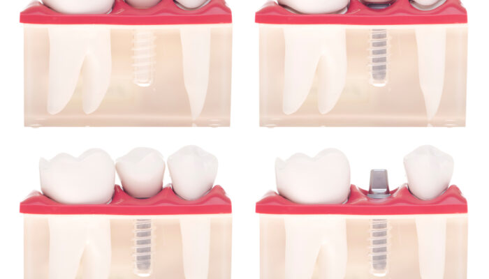 The various types of crowns and caps