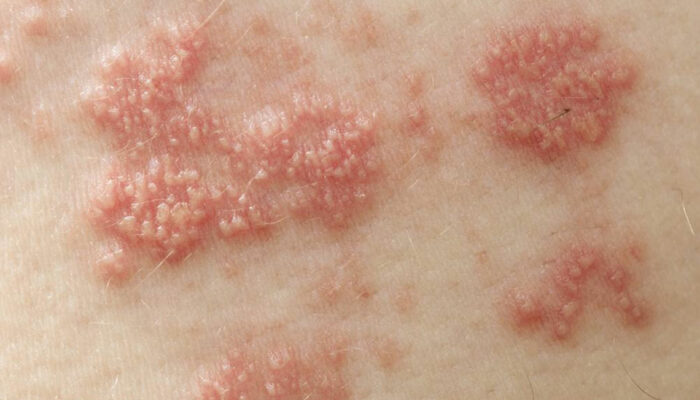 The Treatments for Shingles You Should Know