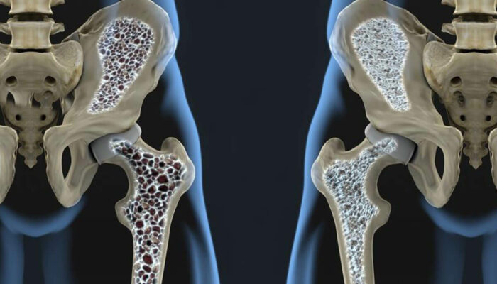 These Common Medical Conditions are Causing Your Osteoporosis Bone Loss