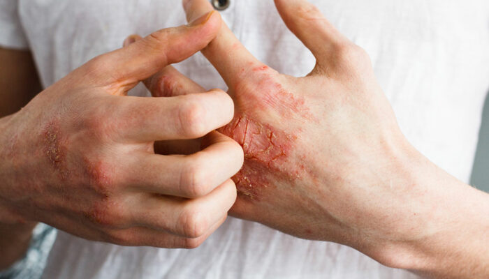 Things You Need to Know about Eczema