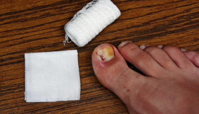 Tips to Cure and Prevent Toenail Fungus