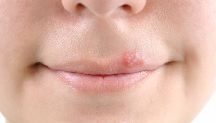 Tips to Treat Cold Sores Effectually