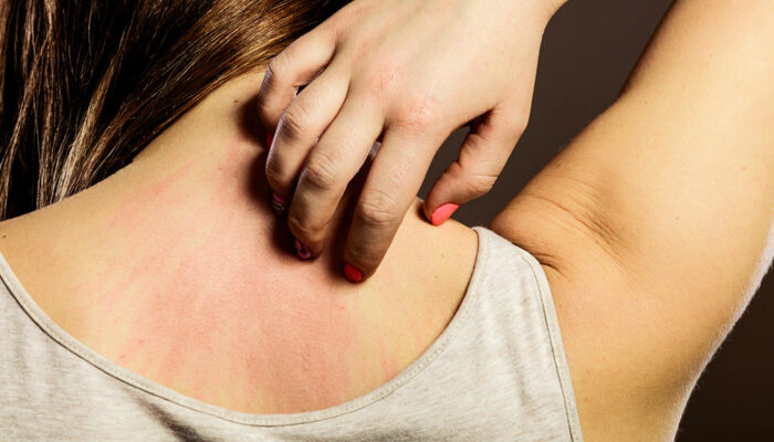 Tips to Treat Pain after Shingles