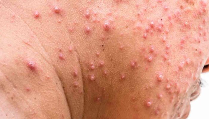 Tips to Treat Shingles Rash