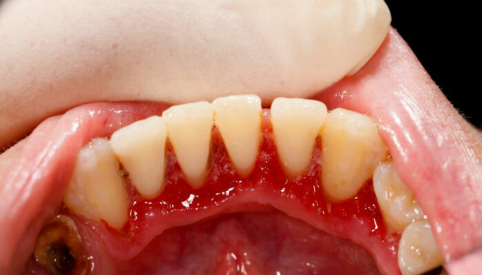 Top 8 natural treatments for gum disease