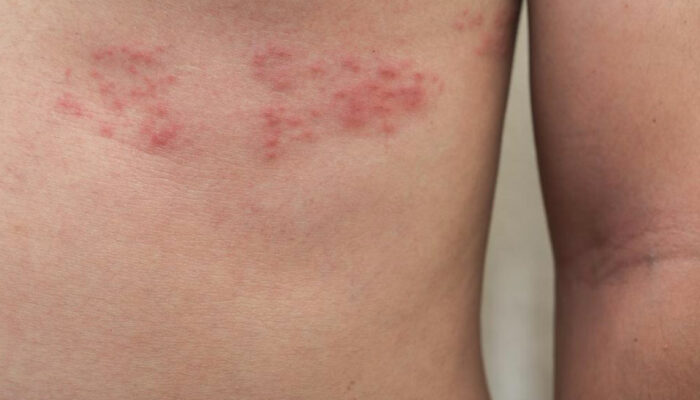 Top 3 Simple Treatments for Shingles You Need to Know