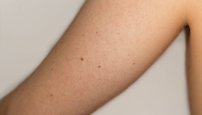 Top Treatment Options for Keratosis Pilaris