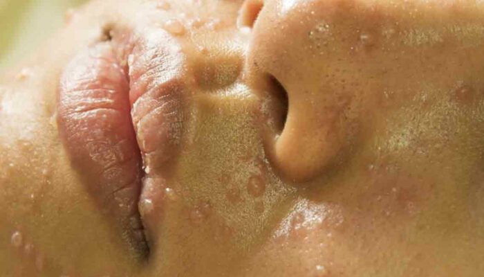 Treat Rosacea With These Natural Medicines and Remedies