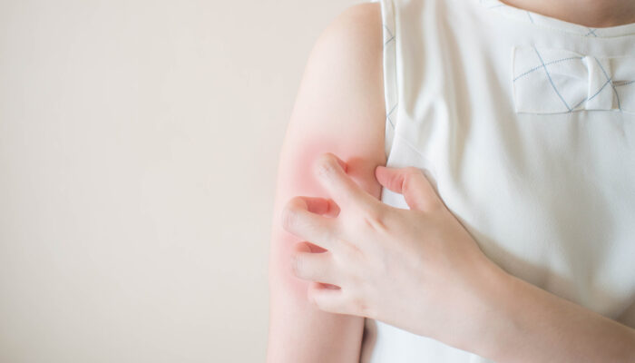 Treatment Options For Psoriasis