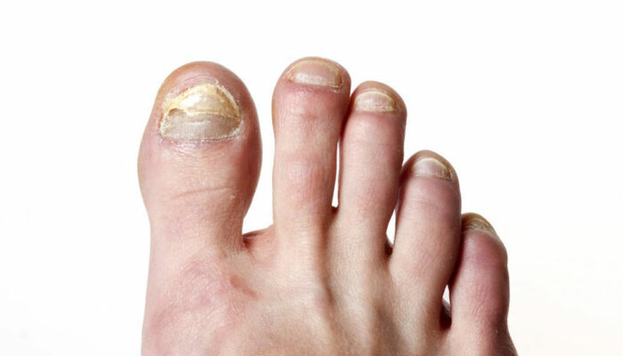 Tried and Tested Natural Cure for Toenail Fungus