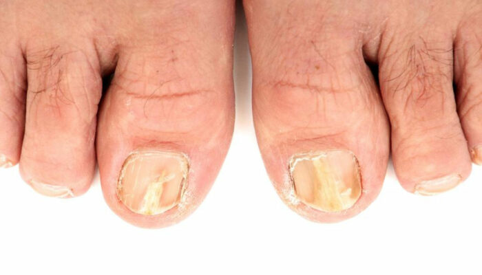 Try These 5 Ways to Effectively Treat Toenail Fungus