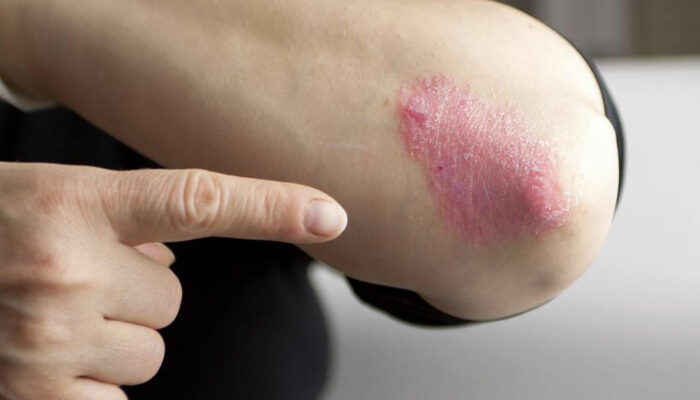 Types and Treatment of Chronic Psoriasis