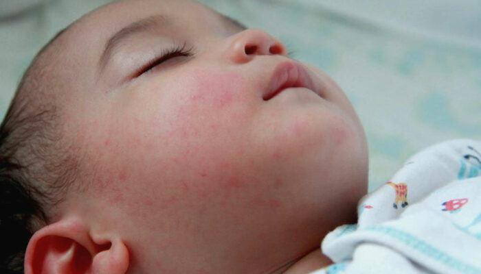 Understanding the Signs and Symptoms of Baby Eczema