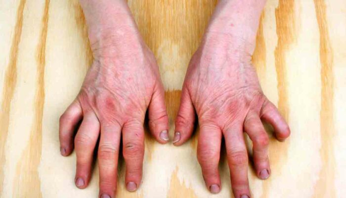 Understanding the Symptoms of Rheumatoid Arthritis