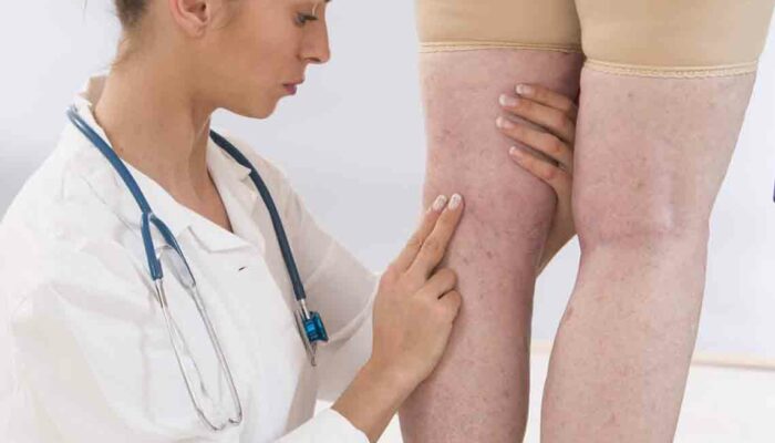 Various Symptoms of Deep Vein Thrombosis Worth Knowing