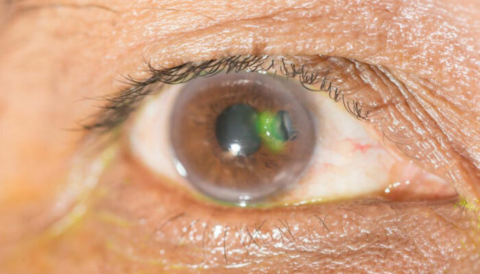 Various eye diseases and their symptoms