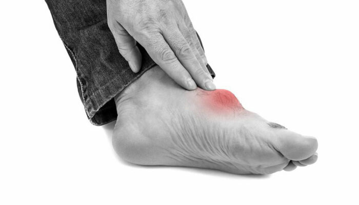 What You Need to Know about Gout