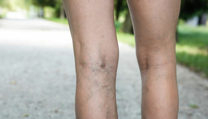 What You Need to Know about Deep Vein Thrombosis