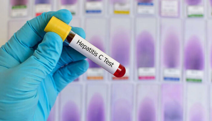 What to Expect from Hepatitis C Treatment