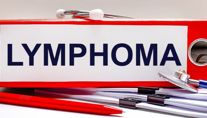 All you need to know about B-cell follicular lymphoma