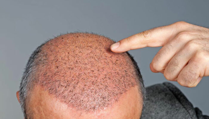 Hair Transplant Cost and Procedure