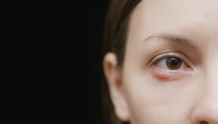 3 Ways to Get Rid of a Chalazion