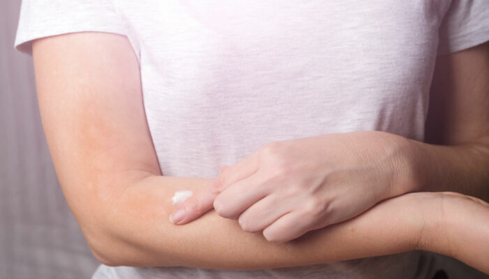 Itchy Skin &#8211; Best Anti-Itch Creams and Home Remedies