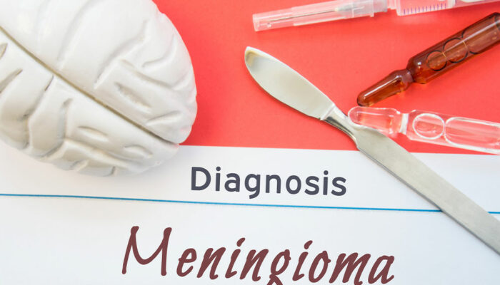 Meningioma &#8211; Symptoms, Causes, Diagnosis, and More