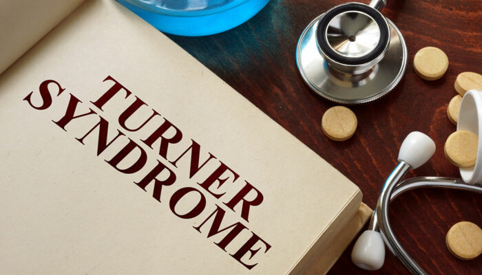 Turner Syndrome &#8211; Causes, Symptoms, and Management