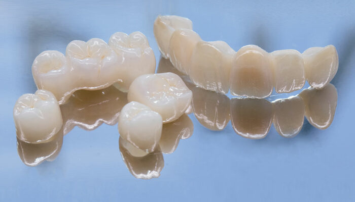 Things to Know Before Opting for Dental Bridges